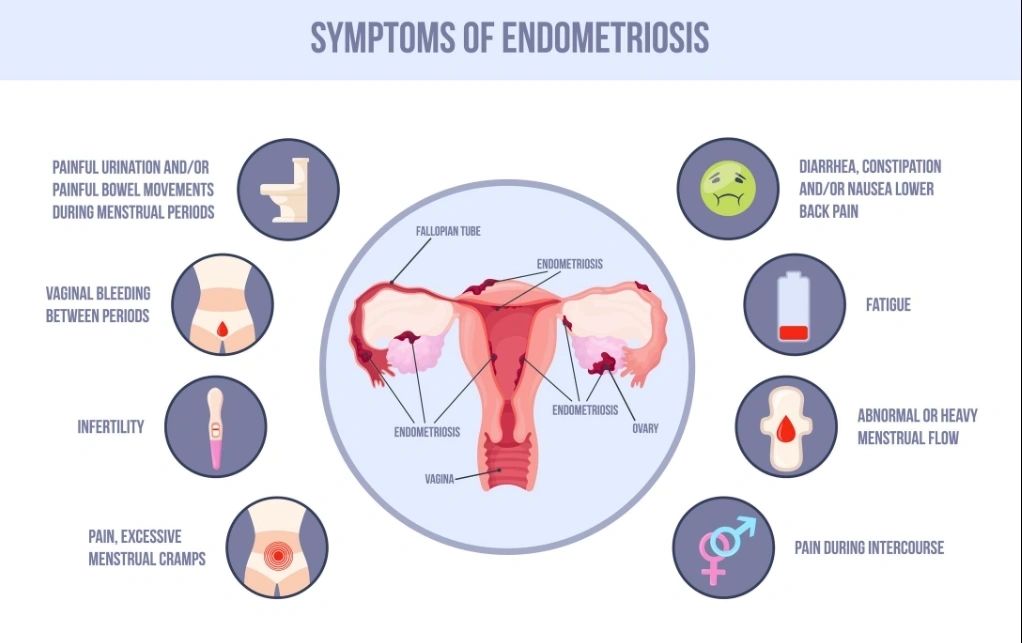 Endometriosis Diagnosis Is Finally Changing Screenshot 202026 03 15 20093618